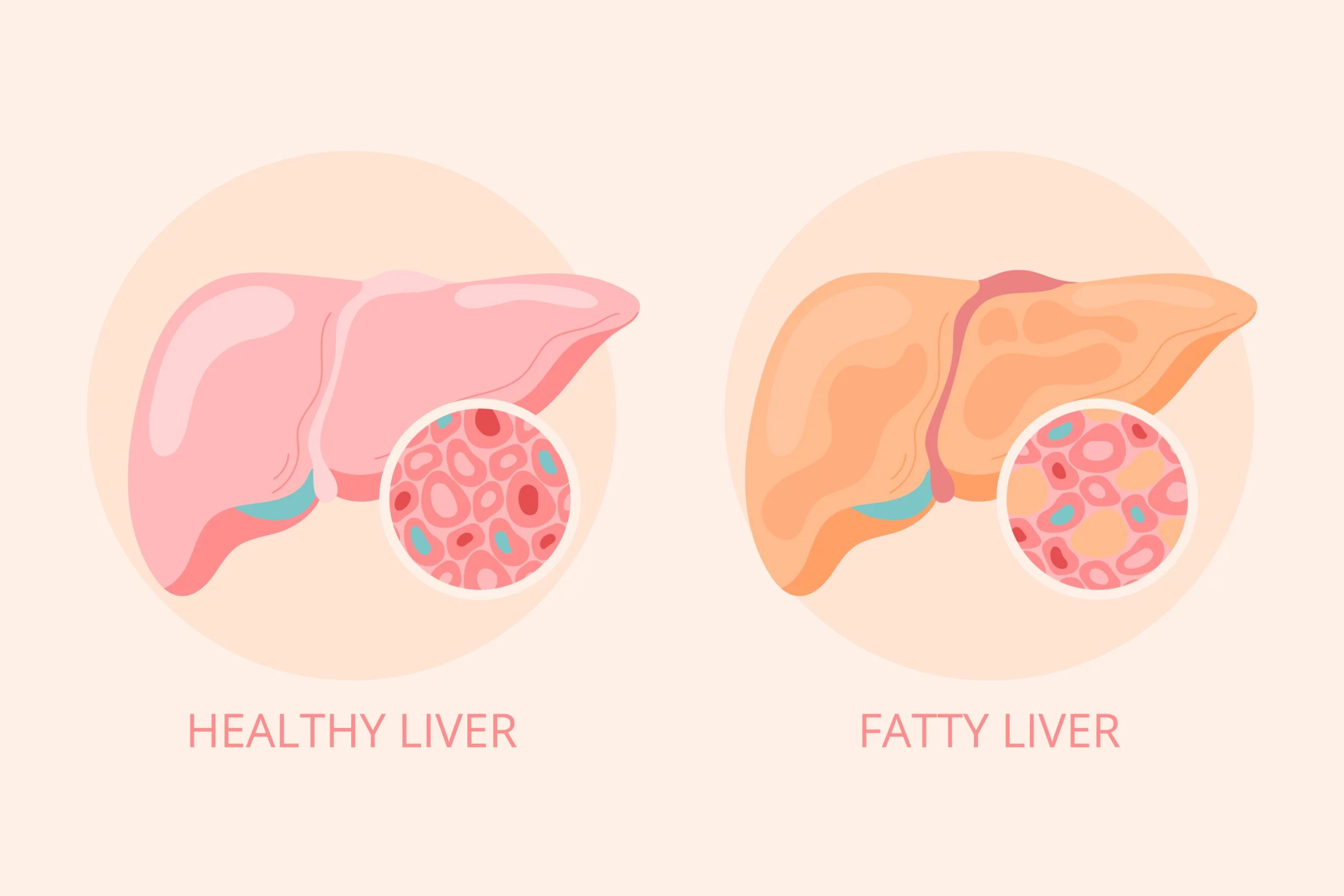 Fatty Liver
